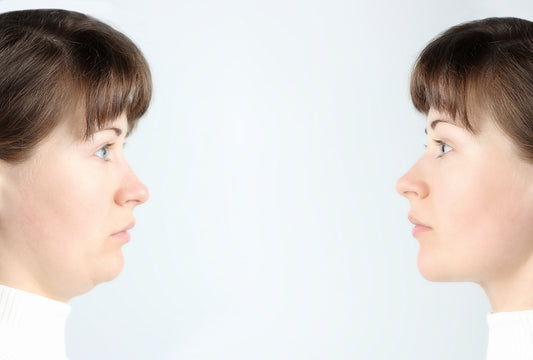 easiest way to get rid of sagging jowls